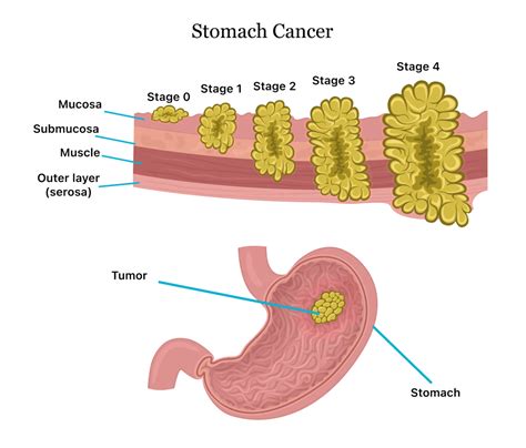 gastric lymphoma survival rate.